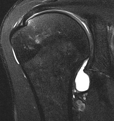 MRI Normal IGHL